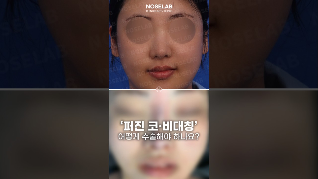 퍼진 코와 비대칭 콧구멍 교정, 휘어진 보형물 교정 코재수술 사례