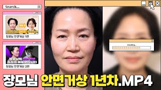 장모님 안면거상 1년 차