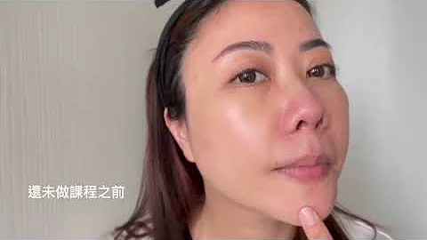 WIQO UNO Real Reviews by Patients #01