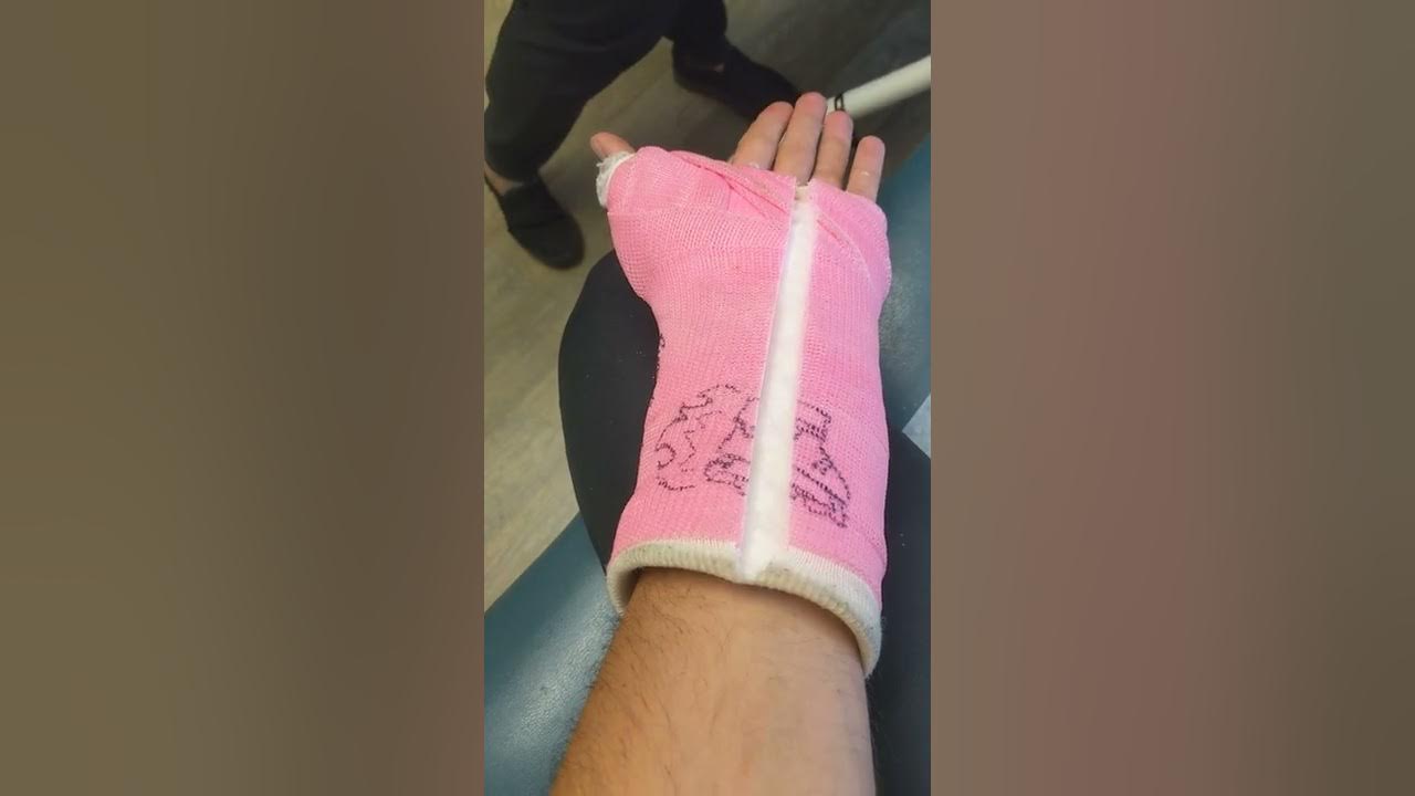 left hand cast removal 5th metacarpal fracture and scaphoid fracture YouTube