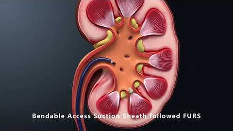 Bendable Access Sheath with Suction