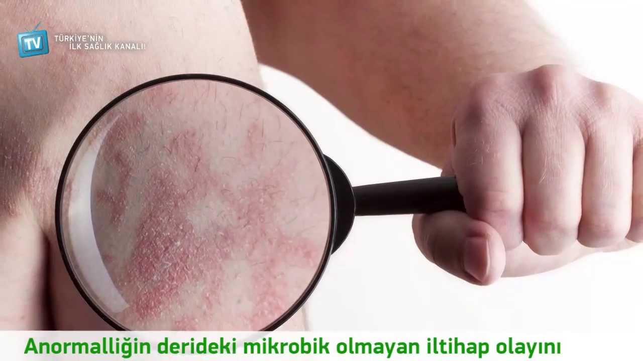 Sedef Hastalığı Nedir - YouTube