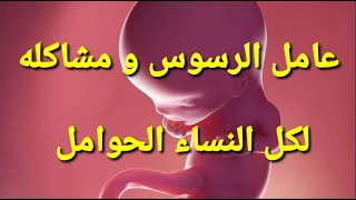 د . فيصل سرو     |    شرح مبسط ...........  عدم توافق عامل الرسوس بين الام الحامل و حميلها ️?