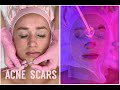 Acne Scar Resurfacing & Enzyme Tightening Facial | Jadeywadey180