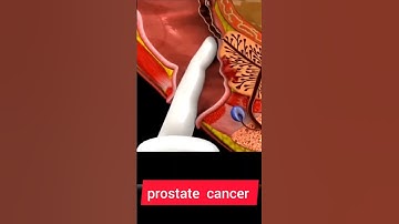 PROSTATE  CANCER  || PROSTATE CANCER ANIMATION  #howtogetsuccessinlife #biologyislife #getsuccess