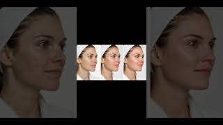 Deep-Dive_ Microneedling Radiofrequency (MNRF) Training at The Derma Academy Germany #skincare