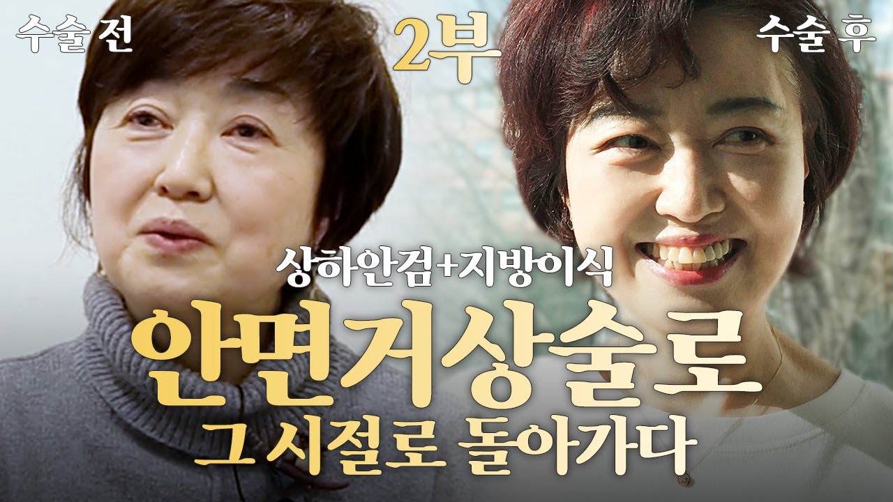 (2부)안면거상수술로 그 시절로 돌아갈 수 있을까?? _후기편