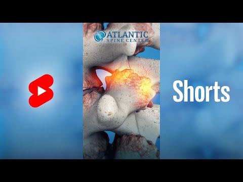 What Are Spinal Bone Spurs? | Spinal Osteophytes #Shorts