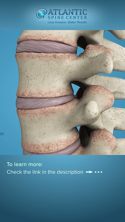What Are Spinal Bone Spurs? | Spinal Osteophytes #Shorts
