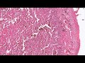 Chronic pulmonary congestion  histopathology