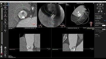 6 Virtual Valve   3Mensio Tutorial Video for TAVR Aortic Valve