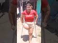 amazing stump amputee #love #amputationjourney #stumping #coto #AmputeeLeeg #amputada #amputado