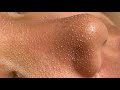 【韓国式3D毛穴洗浄】毛穴の角栓をごっそり吸引ASMR blackheads