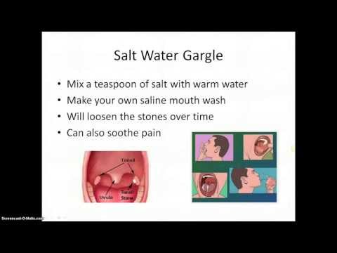 Get Rid Of Tonsilloliths Naturally Get Rid Of Tonsilloliths Naturally