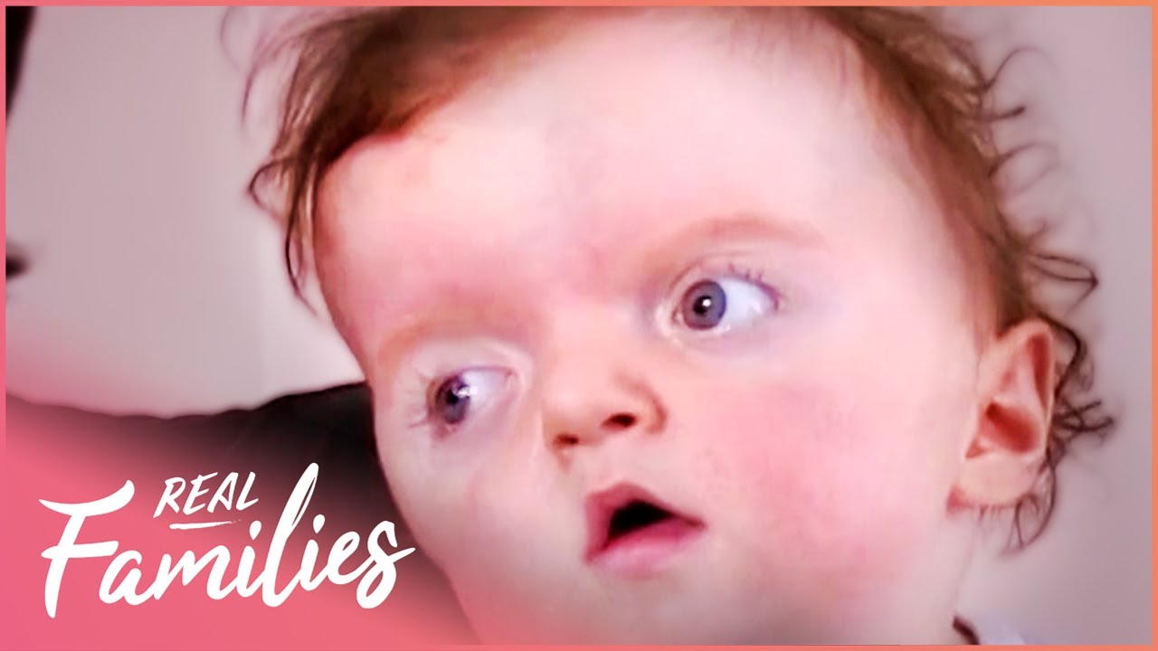 Apert Syndrome Baby Has Excess Brain Fluids | Little Miracles S3E23 | Real Families with Foxy Games