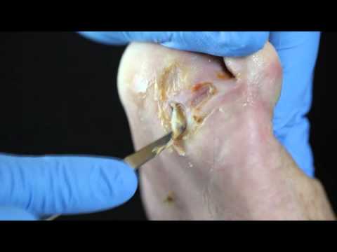 Debridement of a diabetic foot ulcer - YouTube