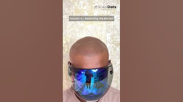 A complete scalp micropigmentation procedure. #scalpmicropigmentation #happypatientstory #smp