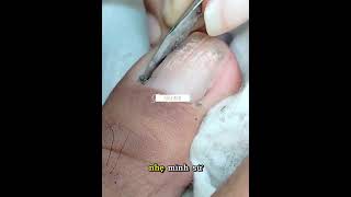 Deep Ingrown Toenail Extraction!