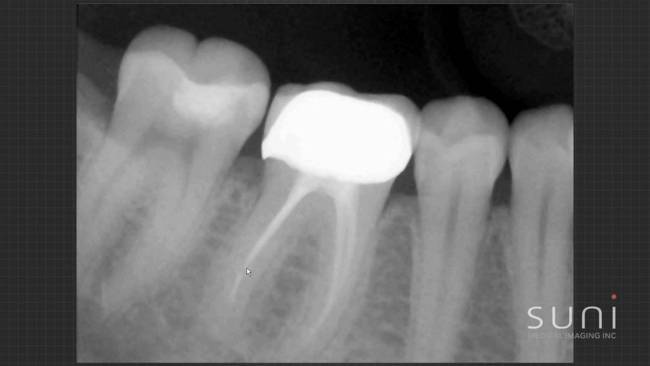 Intraoral Case Studies Imaged with Suni Sensors: Chapter 5