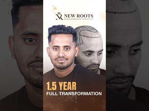4000 Grafts Hair Transplant in Bangladesh | Cost and Best Results #hairtransplant #shorts