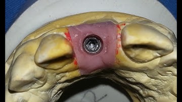 Implant Level Impression with Open Tray Technique Using Pick  Up Impression Coping  Case By Dr  Akas