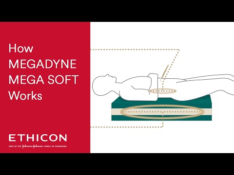 How MEGADYNE MEGA SOFT Patient Return Electrode Works | ETHICON