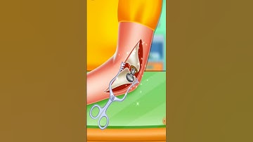 hand surgery and calening #shorts