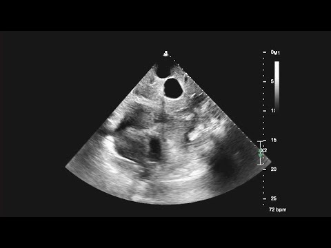 Video: Pengaliran Pericardial Dengan Tamponade: Ultrasonografi Sisi Katil Menjimatkan Kehidupan Yang Lain