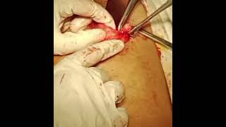interval appendectomy / appendicular lump / recurrent appendicitis