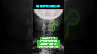 Osteochondroma of the Cervical Spine #bones #radiology #anatomy