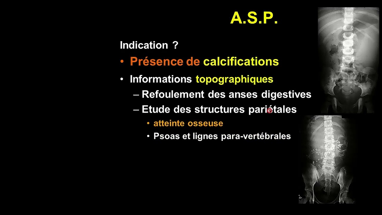 lifebuoy Partie 05 Tumeurs Abdominales De L'Enfant