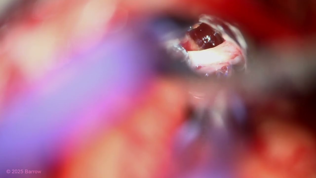 Trans-Middle Cerebellar Peduncle Approach for a Middle Peduncular Pontine Cavernoma Resection