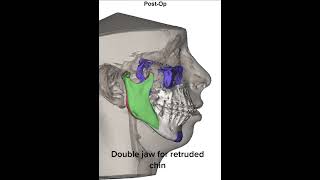 Surgical program of a class III malocclusion