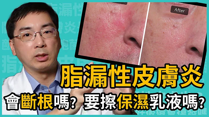 脂漏性皮肤炎会断根吗？需擦保湿乳液吗？皮肤科林政贤医师完整保养教学一次告诉你！ - 天天要闻