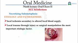 د. محمد الوصابي  Ninth lecture  Oral Ulcers I, SCC &Infections طب الفم  Oral Medicine