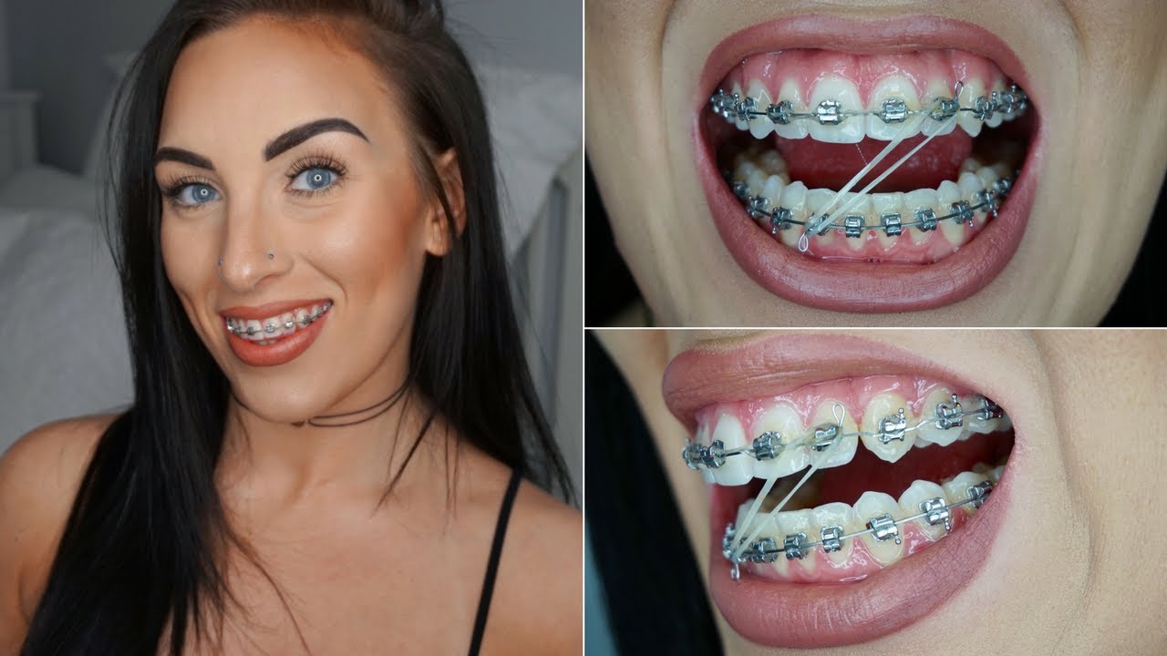What do Braces Bands Do and What secrets do they reveal?