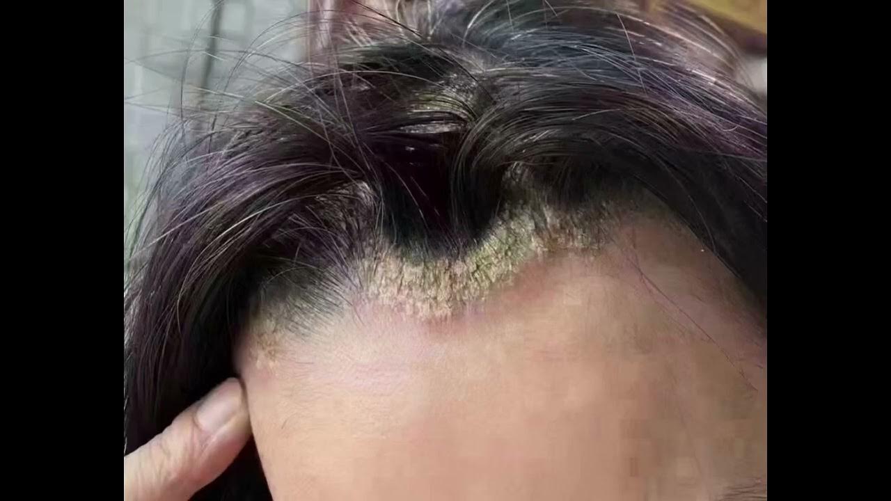 SATISFYING BLACKHEAD REMOVALL SUPER BLACKHEADS YouTube