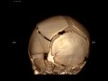 Left Parietal Scalp Hematoma after Fall in 17 day old baby boy