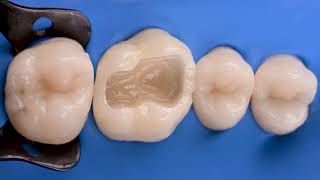 CLEARFIL Universal Bond Quick 2: grabado total