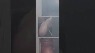 Parasite Lady Medical Mystery