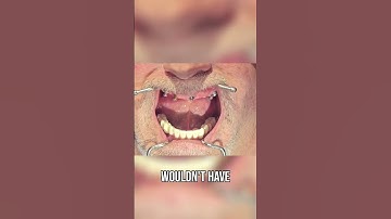 Dental Implants: Multi-Unit Abutment Placement Technique Explained