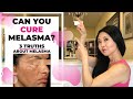 Can You Cure Melasma?  The 3 Truths About Melasma