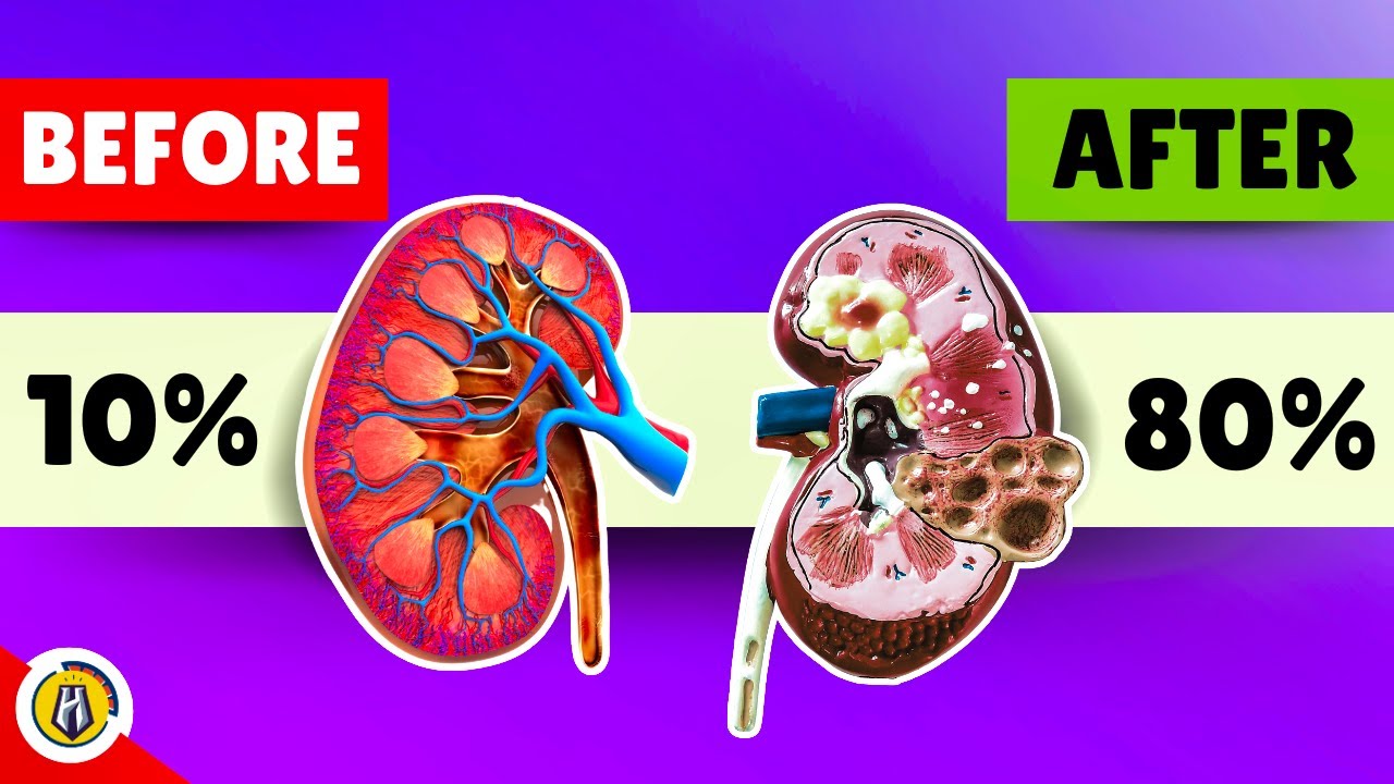 Chronic Kidney Disease Chronic Kidney Disease Treatment, Risk Factors