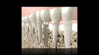Kissimmee Dental Implants - 407-847-0100