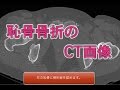 恥骨骨折のCT画像