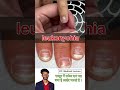 नाखून में सफेद दाग यह हो सकता है leukonychia | #shots #shortsfeed #shortvideos #shortsviral