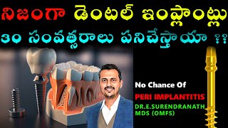 life span of dental implants|30 years guarantee??|in telugu by Dr Surendranath.