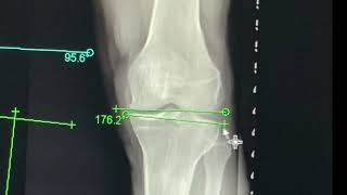 miniaci's Femur