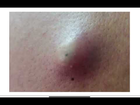 skin cyst details MRCS question solve (CRACK MRCS)