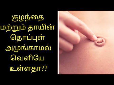 Thoppul amungamal veliyae ulladha??/Belly button came outside after delivery? தொப்புள் உள்ளே அமுங்க!